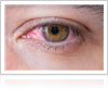 Glaucoma Treatment by Gerstein Eye Institute in Chicago